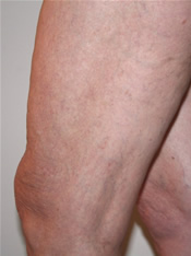 Spider Veins - After Treatment