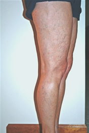 Spider Veins - After Treatment