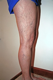 Spider Veins - Before Treatment