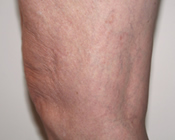 Spider Veins - After Treatment