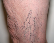 Spider Veins - Before Treatment