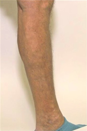 Varicose Veins - After Treatment