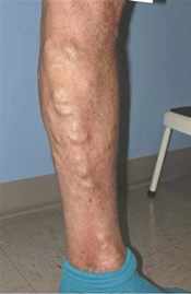 Varicose Veins - Before Treatment