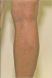 Varicose Veins - After Treatment