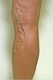 Varicose Veins - Before Treatment