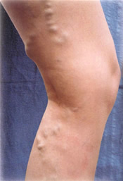 Varicose Veins - Before Treatment