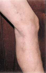 Varicose Veins - After Treatment