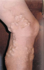 Varicose Veins - Before Treatment